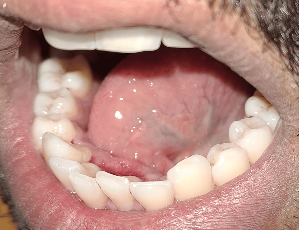 Diode Laser Frenectomy A Torch of Freedom for Ankyloglossia Cureus