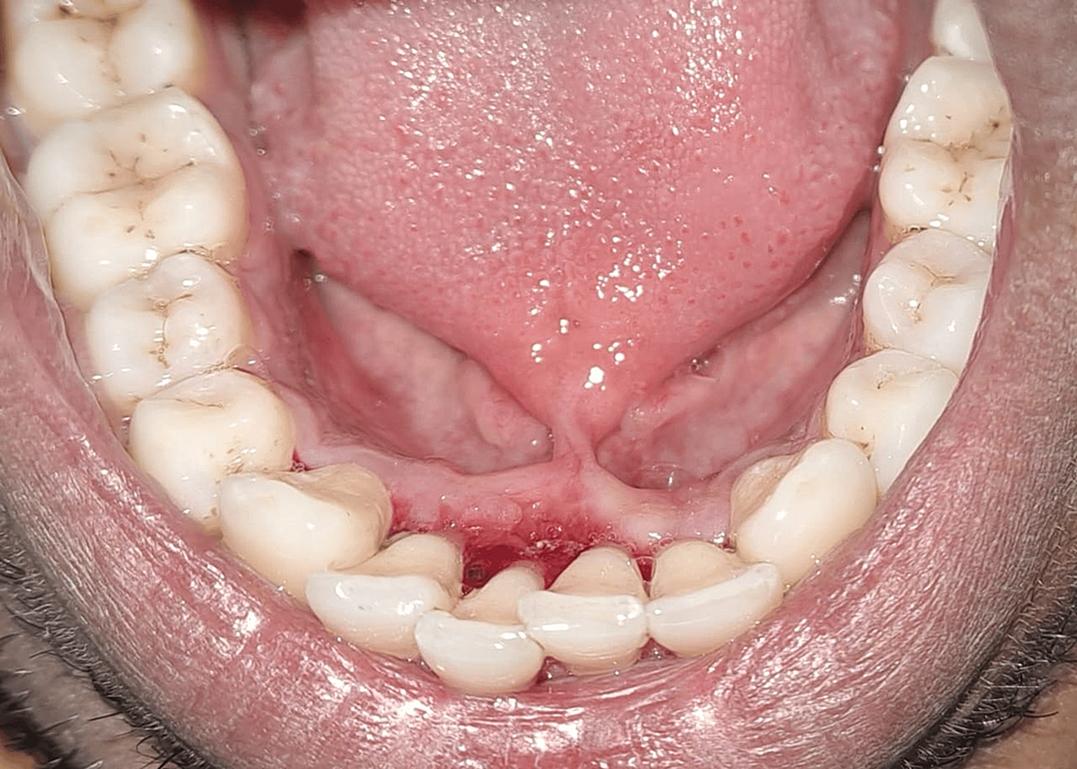 Diode Laser Frenectomy A Torch of Freedom for Ankyloglossia Cureus