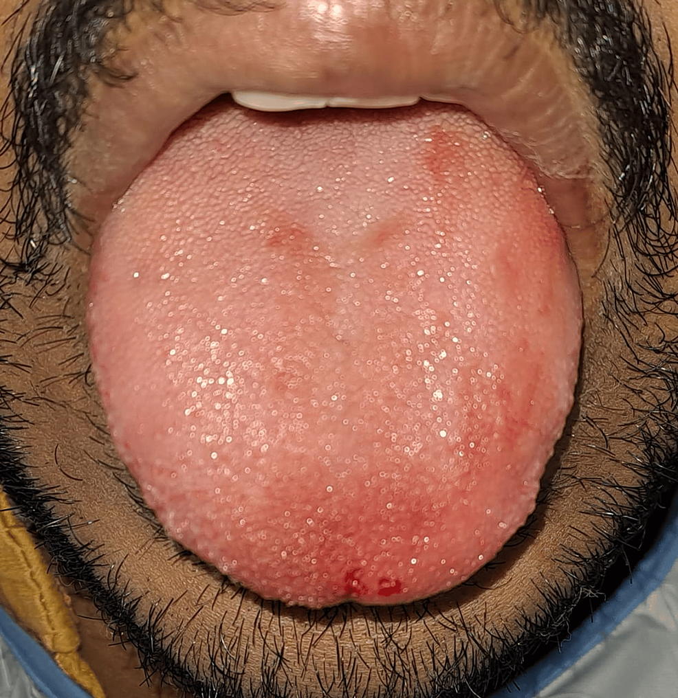 Diode Laser Frenectomy A Torch of Freedom for Ankyloglossia Cureus