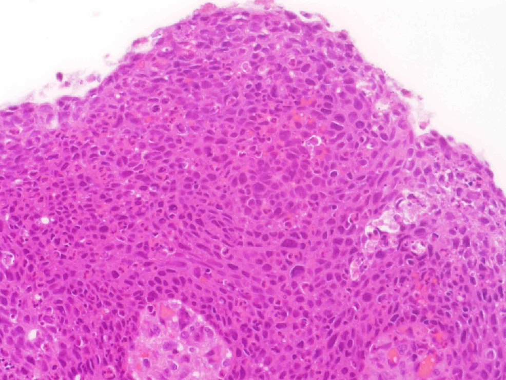 Cureus Inverted Sinonasal Papilloma Involving The Middle Ear With Evidence Of Squamous Cell 2219