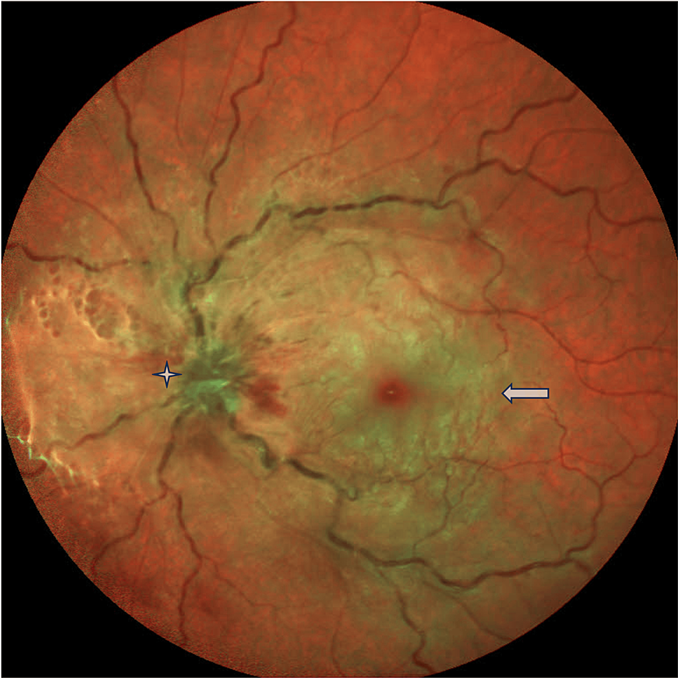 Combined Central Retinal Artery Occlusion (CRAO) and Central Retinal ...