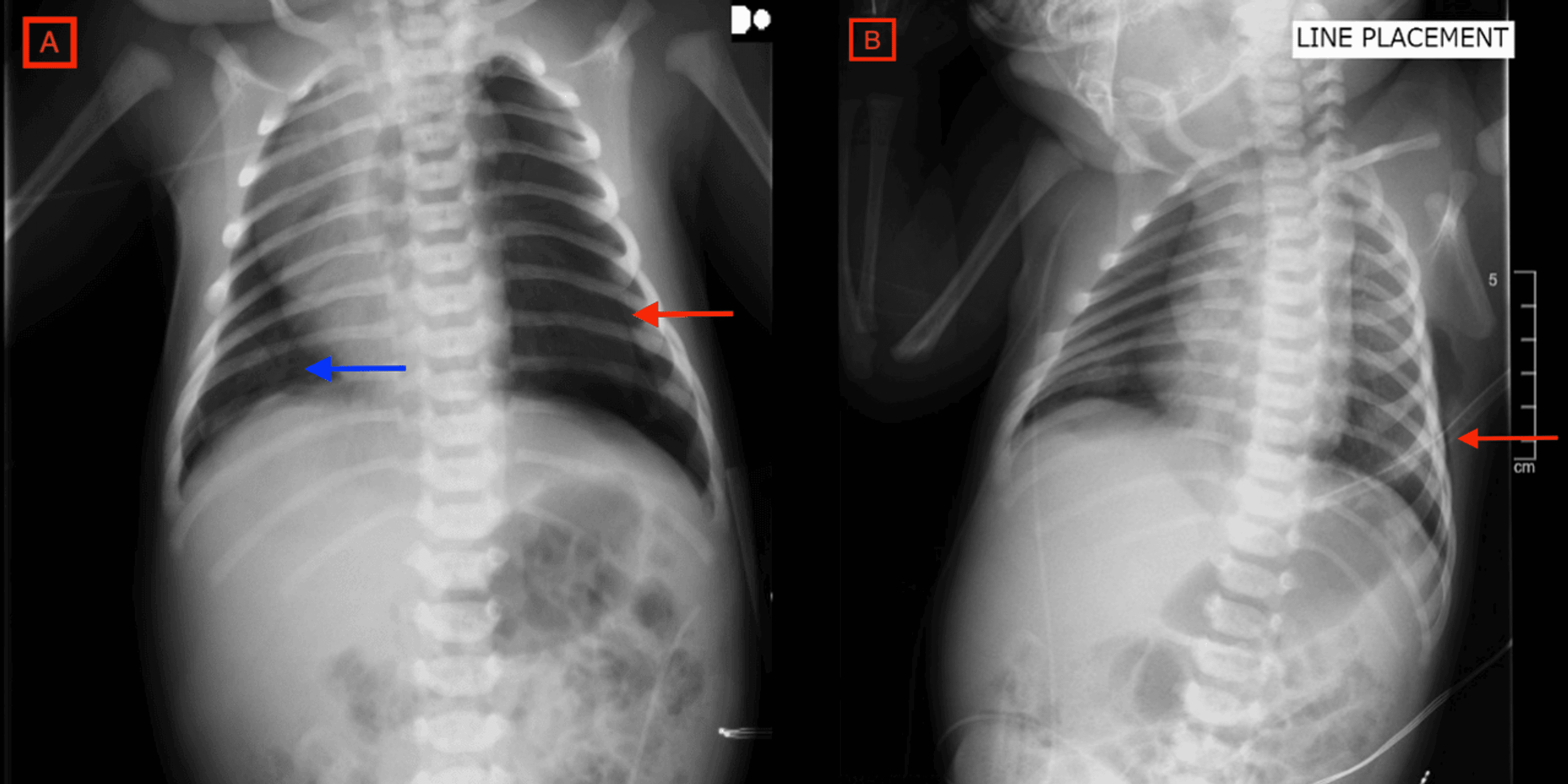 Cureus Neonatal Subcutaneous Emphysema Secondary to Chest Tube