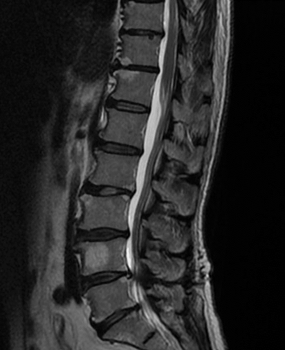 Cureus A Case of Autoimmune Polyendocrine Syndrome Type 3B and