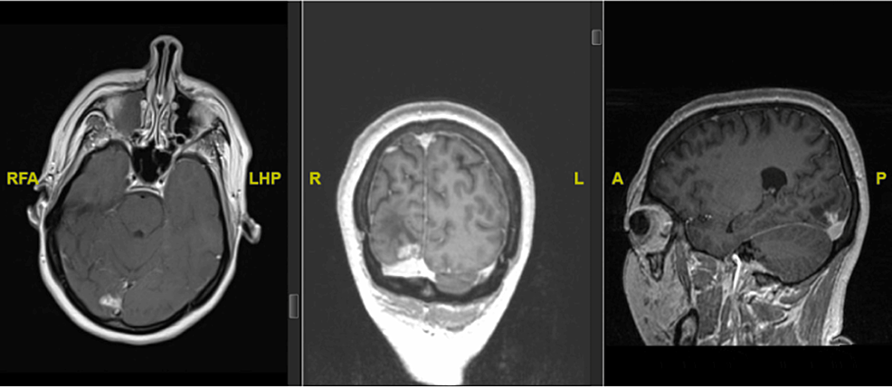 Cureus | Exploring the Role of the Pulvinar Nucleus of the Thalamus in ...