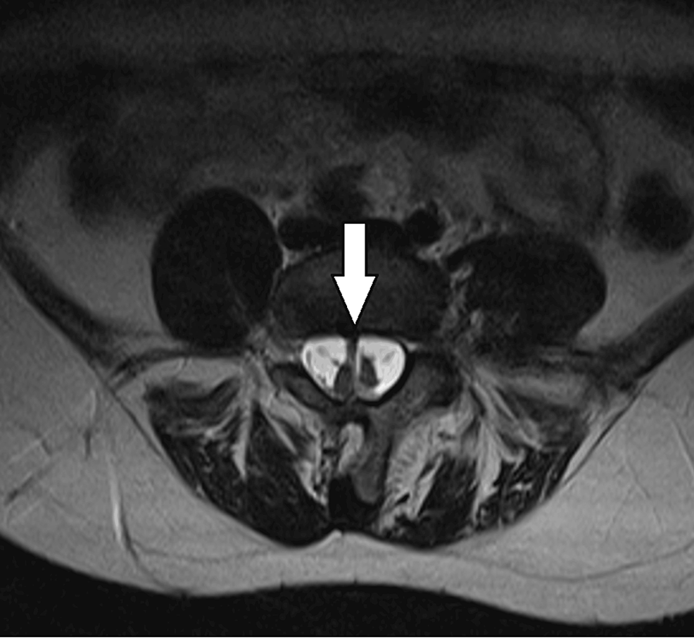 A Rare Case of Lumbar Region Diastematomyelia in a 25-year-old Woman ...