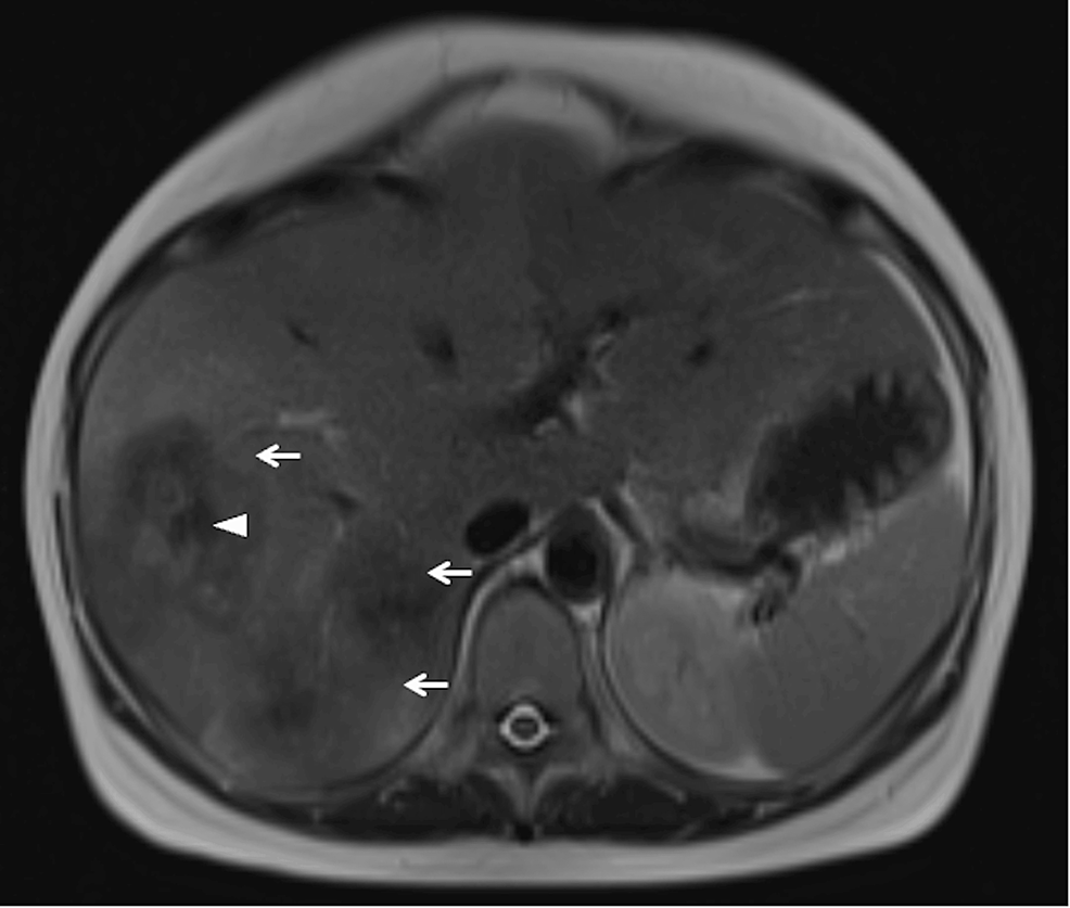 cureus-diagnosis-and-treatment-of-metastatic-colon-cancer-in