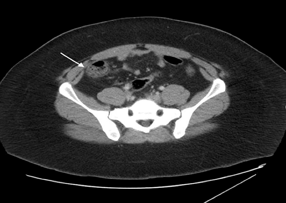 Right Upper Quadrant Pain A Rare Presentation Of Diverticulitis Cureus