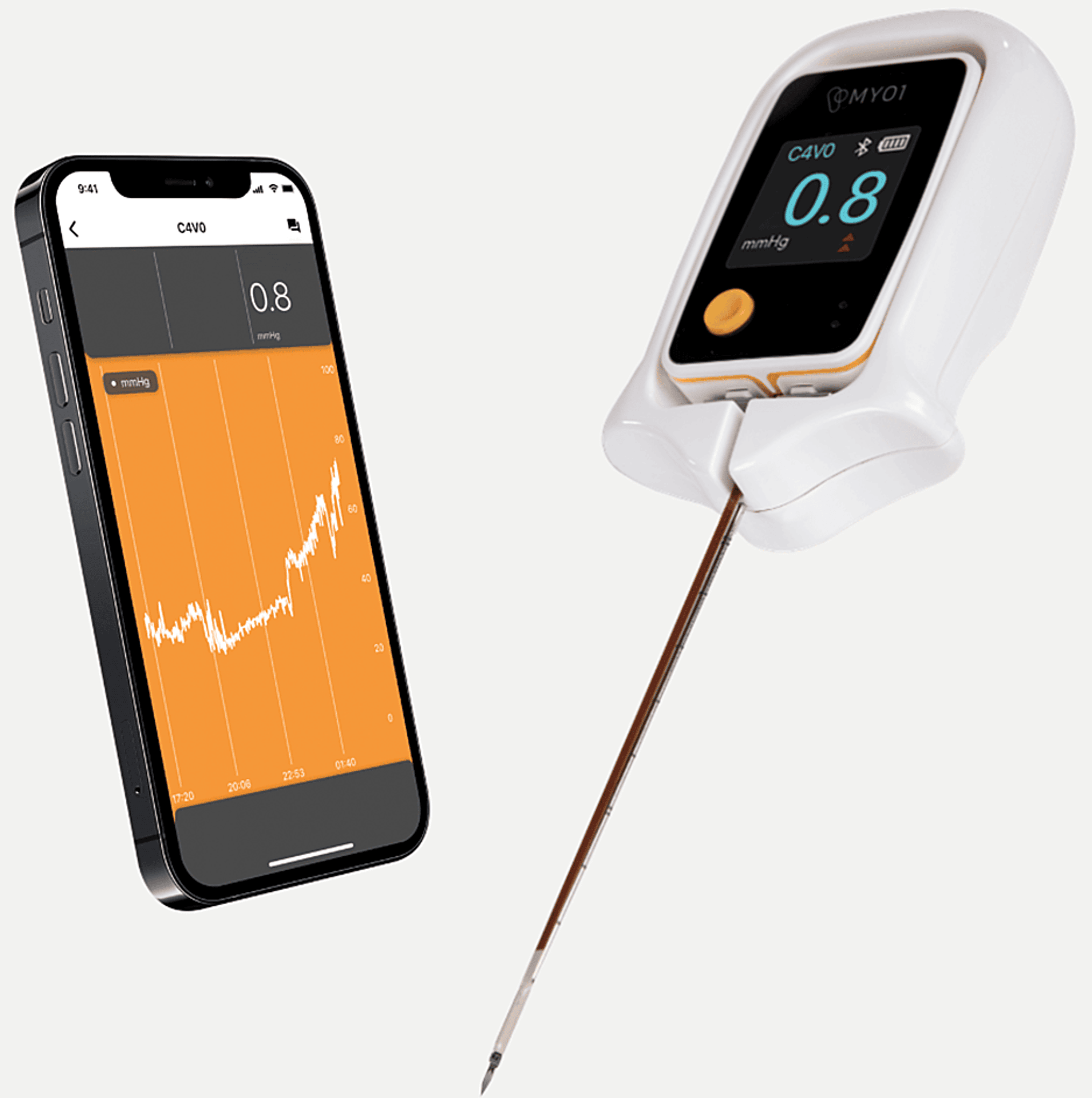 Cureus Continuous Compartment Pressure Monitoring Allows the Early
