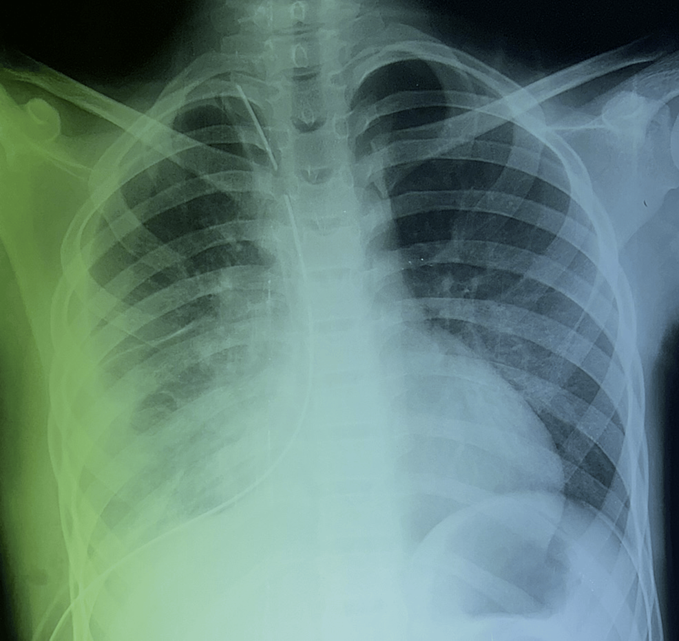 Cureus | Pneumothorax Revealing the Rupture of a Primary Pleural ...