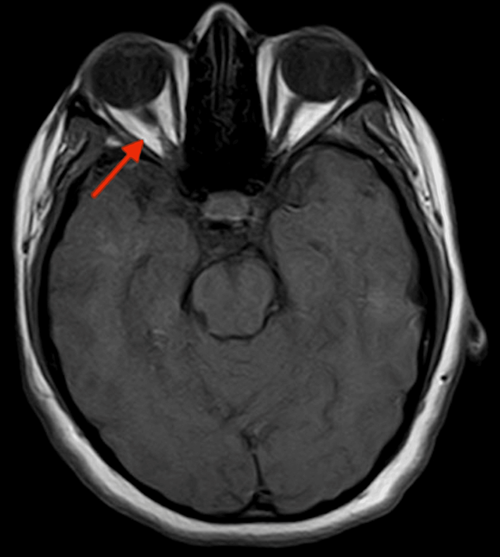 Cureus Optic Neuritis In A 15 Year Old Female Patient A Case Report 