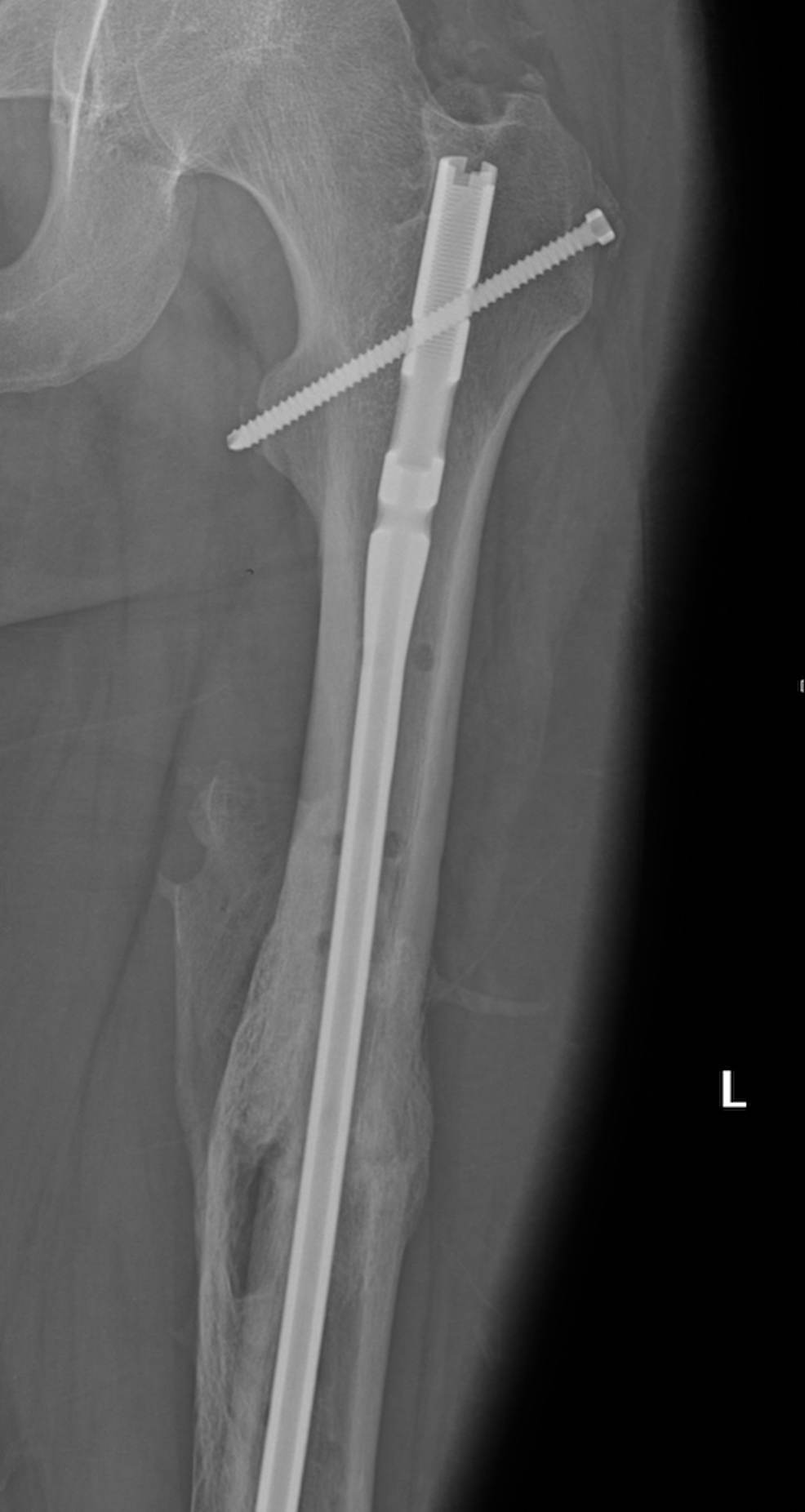 How To Repair A Spiral Femur Fracture