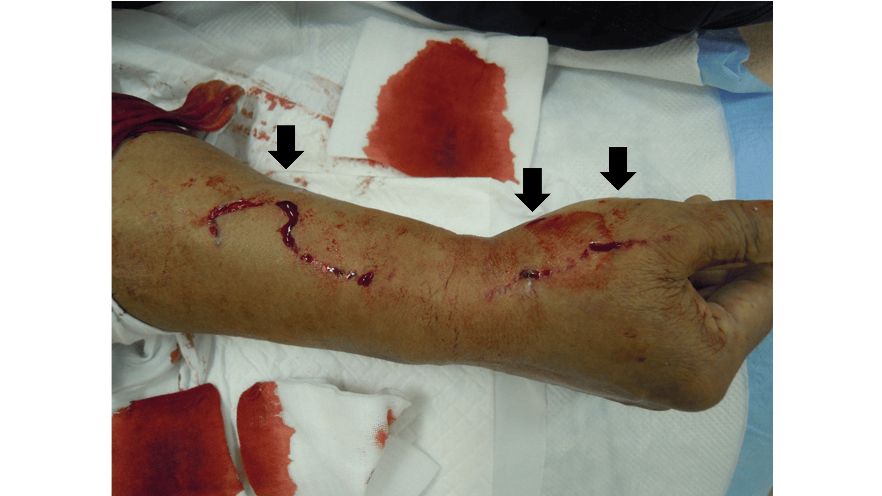 Cureus HighPressure Injection Damage Caused by a HighPressure Washer