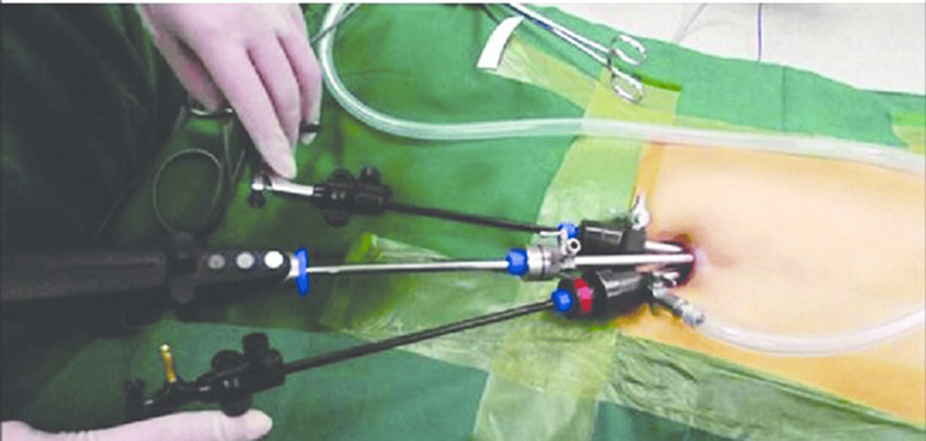 A Comprehensive Analysis of Single-Incision Laparoscopic ...