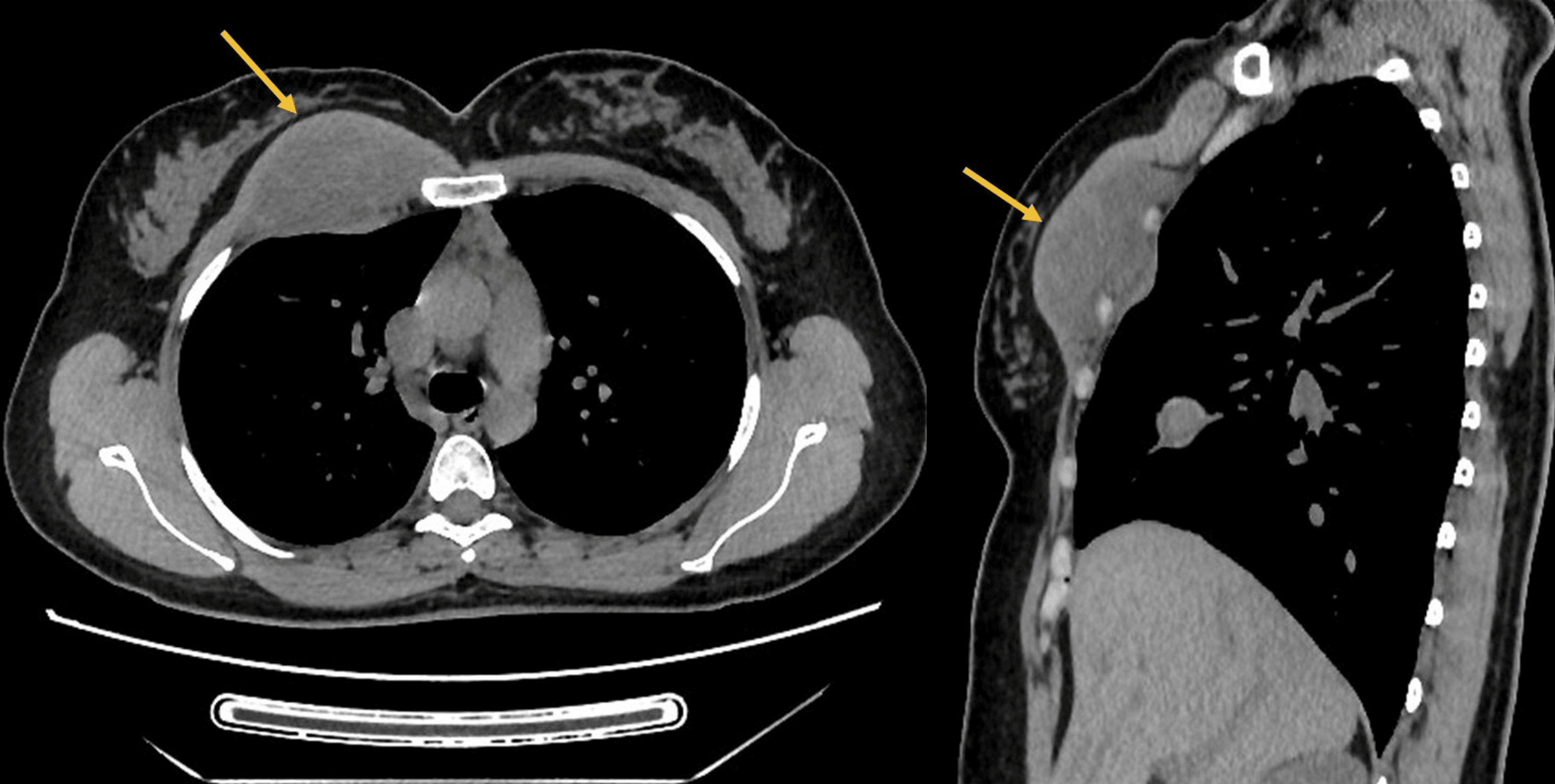 Parietal Thoracic Tuberculosis: A Report Of Two Cases | Cureus