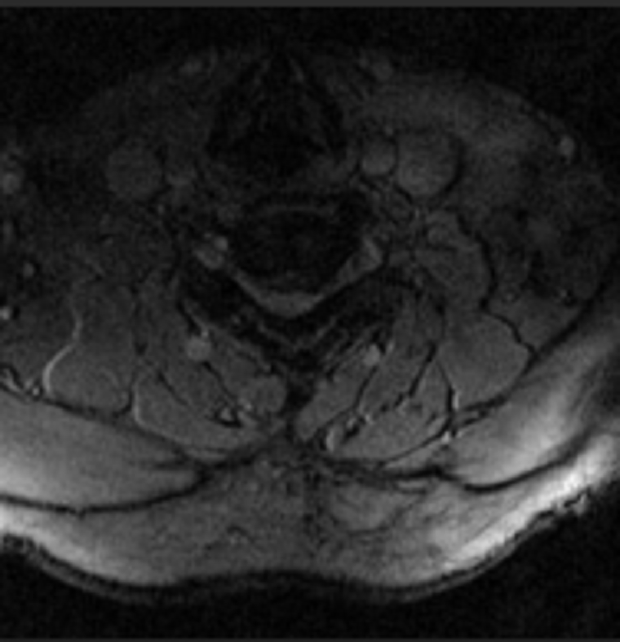 Cureus | Relief of Lumbar Symptoms After Cervical Decompression in ...