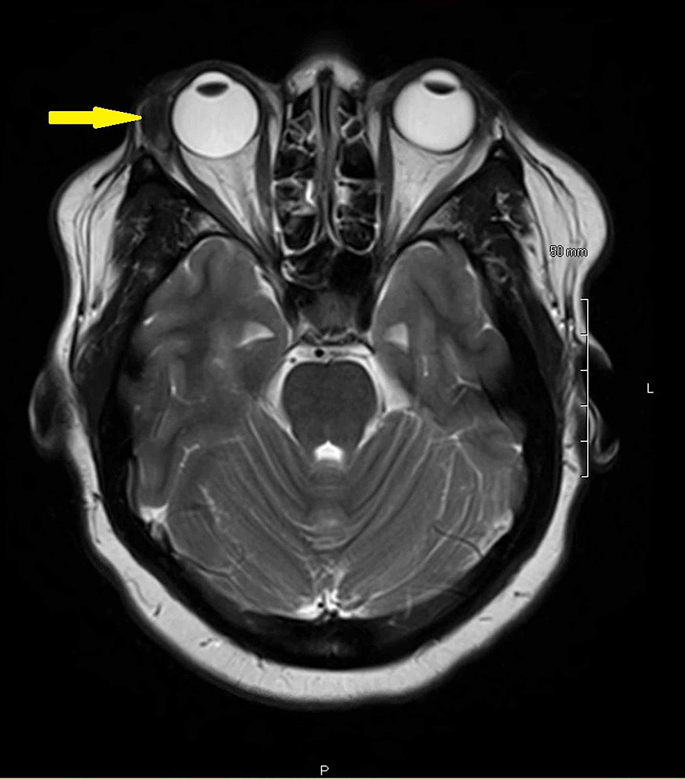 Cureus Primary Isolated Lacrimal Gland Amyloidosis A Case Report and