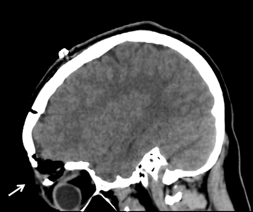 Orbital Intradiploic Epidermoid Cyst A Case Report Of A Rare Entity Cureus 0453