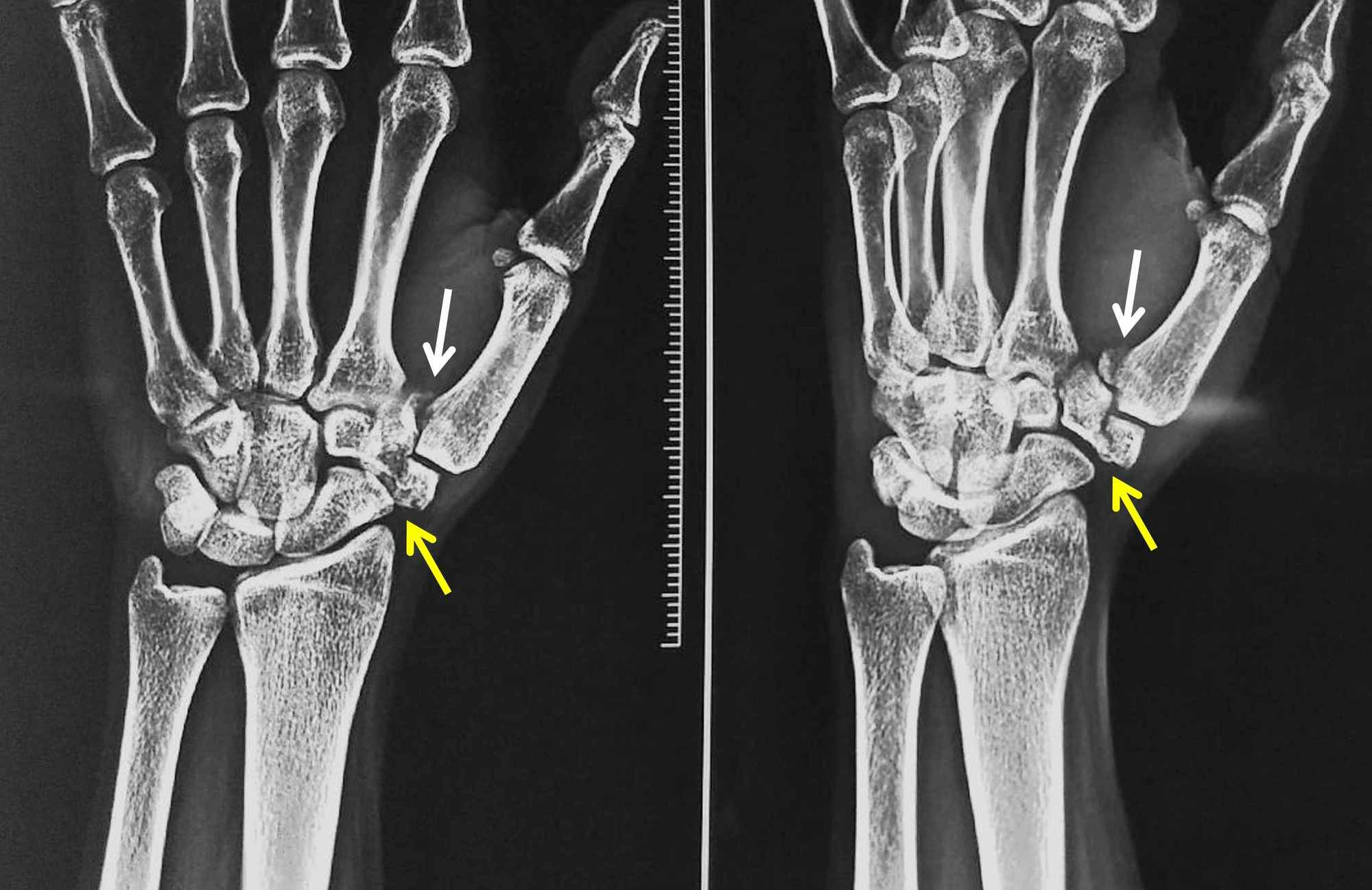 A Bennett S Fracture Dislocation Of The Thumb Results - vrogue.co