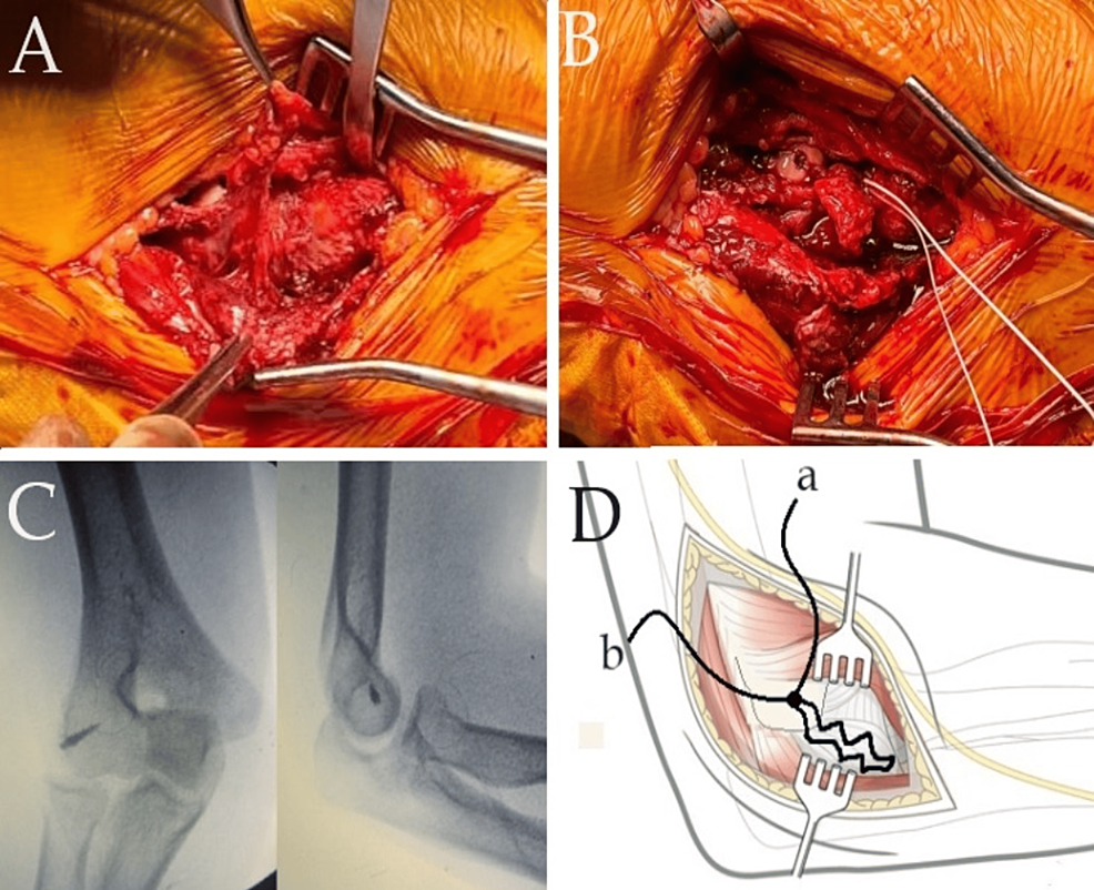 Lateral Collateral Ligament Injury (LCL) - Atlantic Orthopaedic