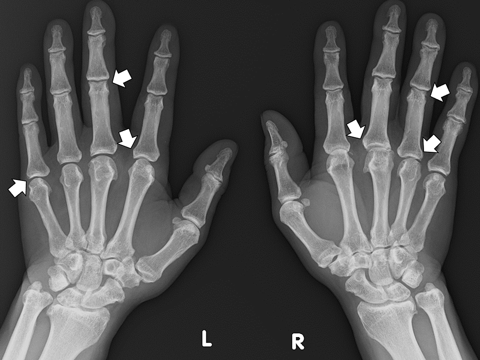 健康・医学 A Colour Atlas of Rheumatoid Hand Hand Rheumatoid Arthritis - Physiopedia