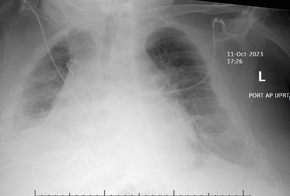 From Collapse to Recovery Thiamine Intervention in Cardiac Beriberi