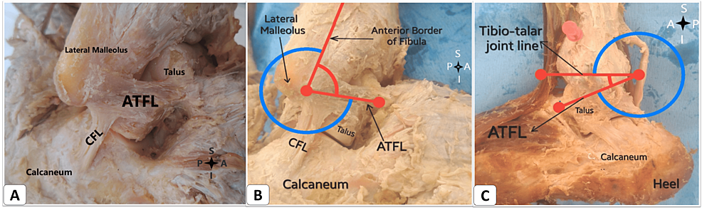 Cureus  Lateral Ankle Ligaments: An Insight Into Their Functional