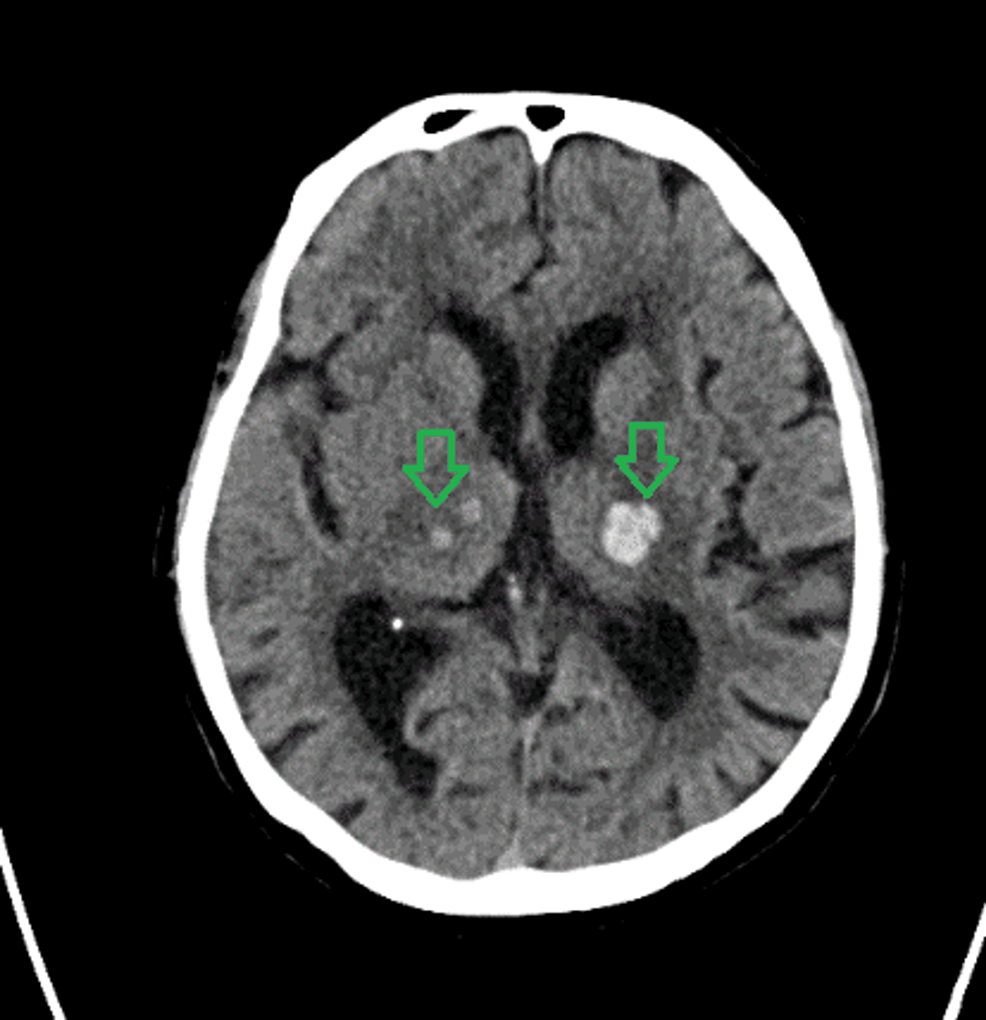 Spontaneous Simultaneous Bilateral Basal Ganglia, Thalamic, and Central