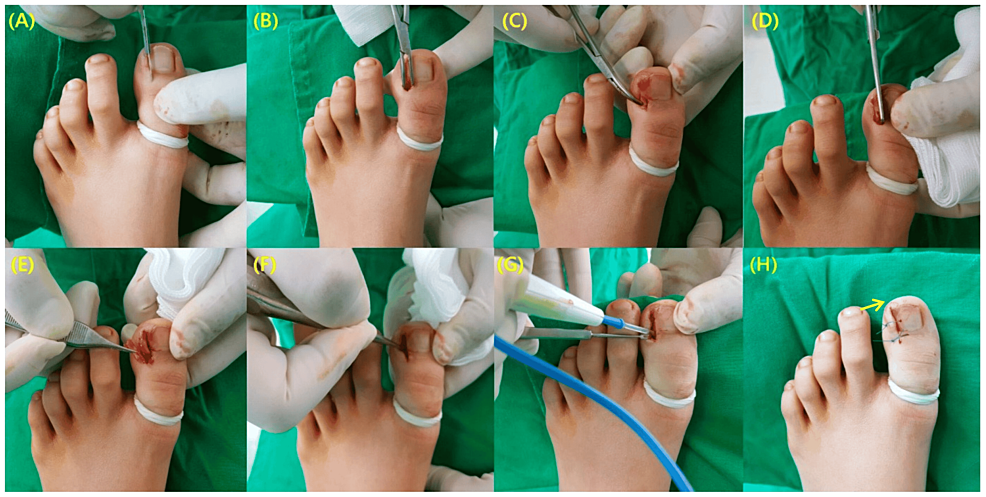 Permanent Ingrown Toenails: Chemical and Surgical Procedures | SpringerLink