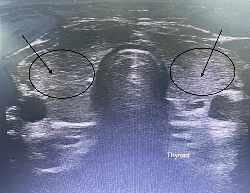 Cureus Hashimoto Thyroiditis Coexisting With Breast Fibroadenoma