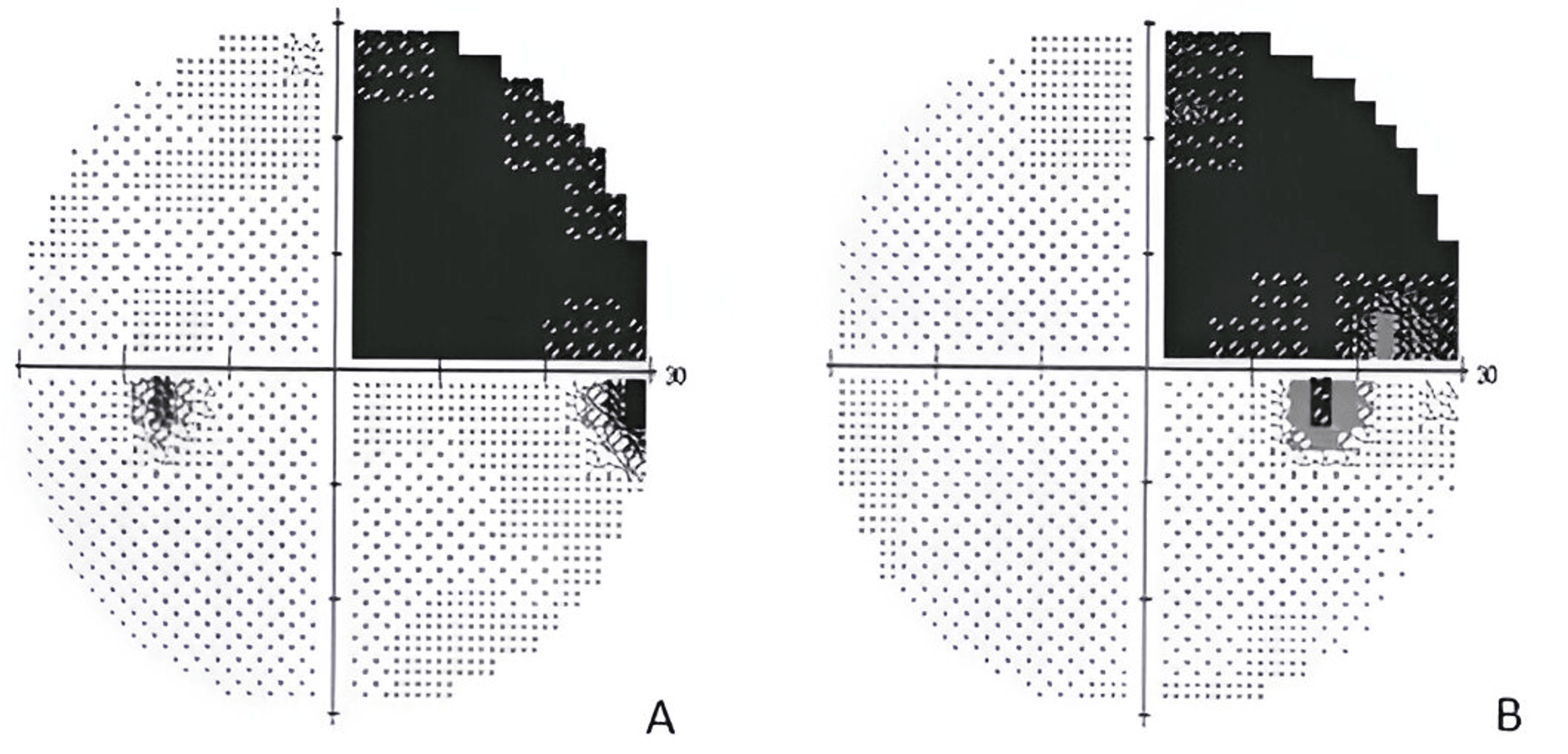 Cureus Beyond Words A Case of Pure Alexia Following Posterior