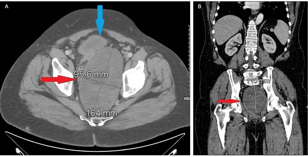 metastatic melanotic schwannoma Malignant Melanotic Nerve Sheath Tumor of the Neck: A Case Report main image 1