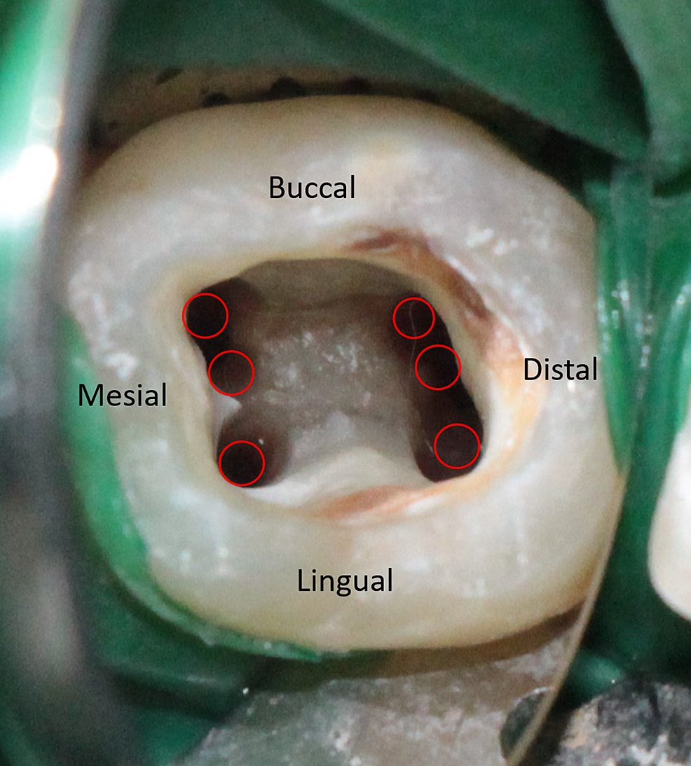 Cureus | Management of Three Rooted Mandibular First Molar with Six ...