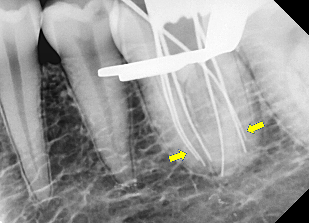 Cureus Management of Three Rooted Mandibular First Molar with Six