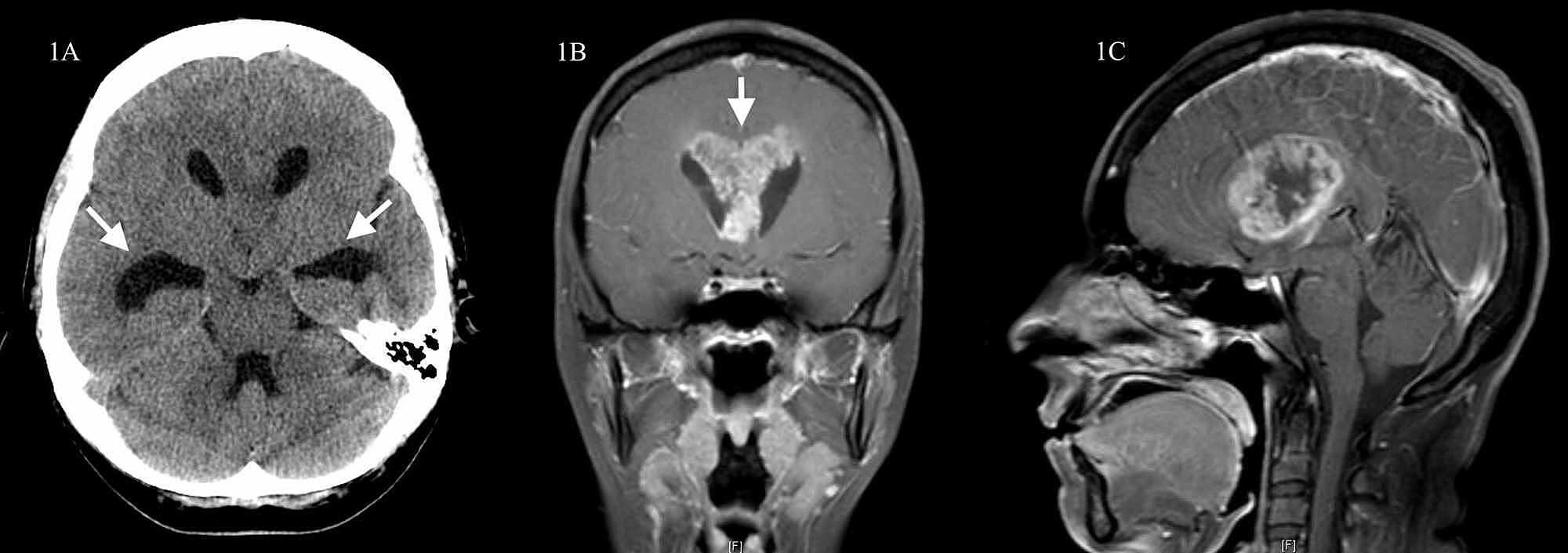 brain tumor mri without contrast