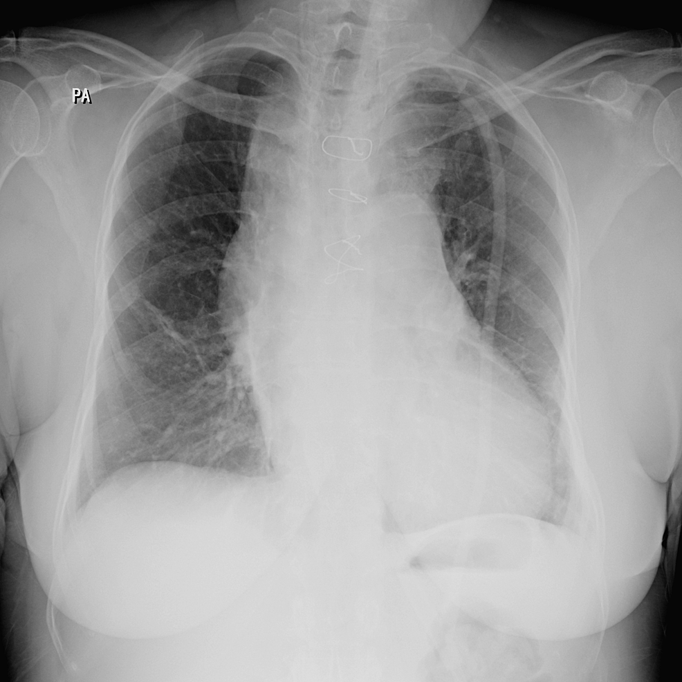 Total Thyroidectomy By Median Sternotomy For Treatment Of Substernal