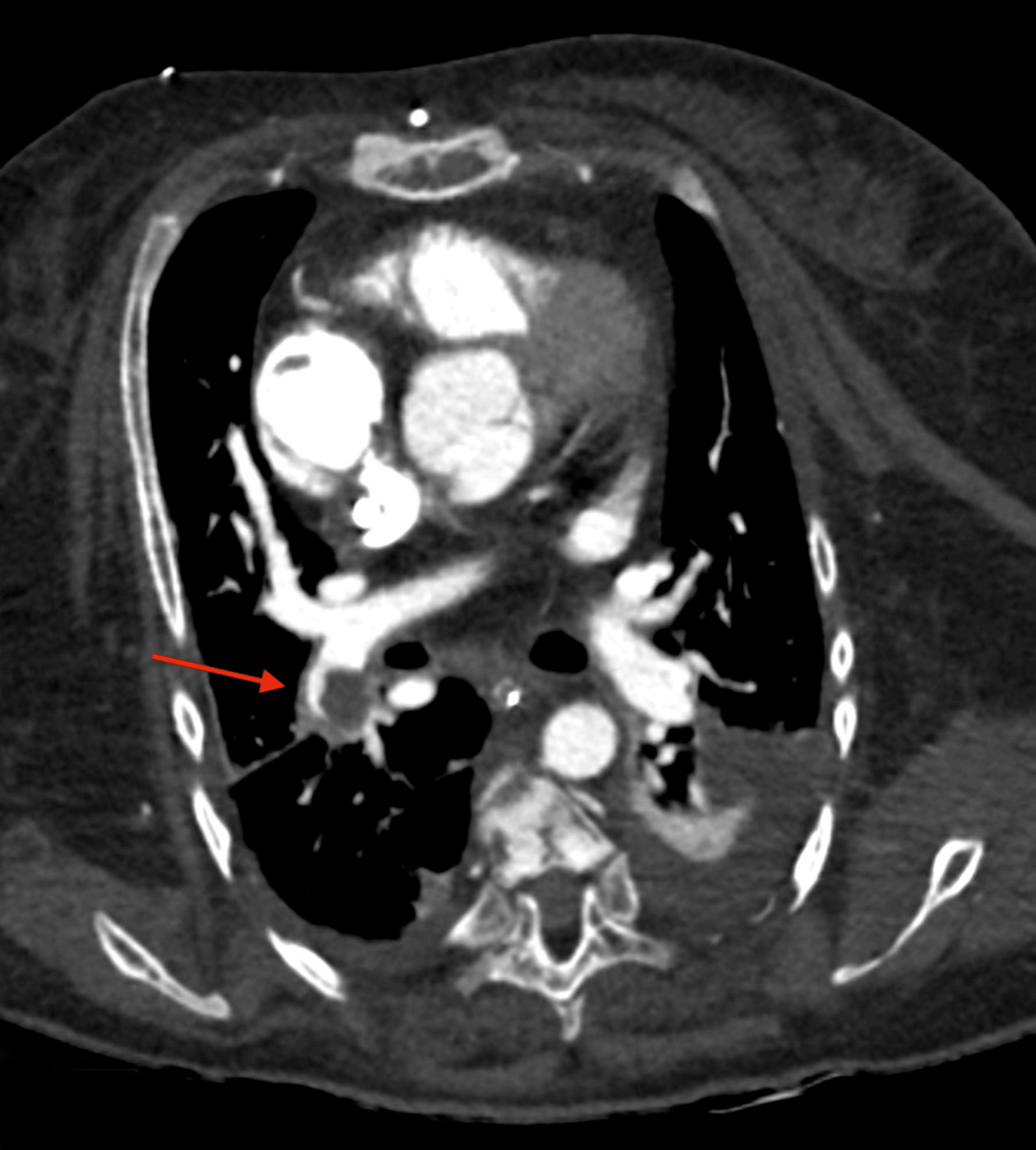 Cureus CatheterRelated Right Atrial Endocarditis in a Dialysis Patient