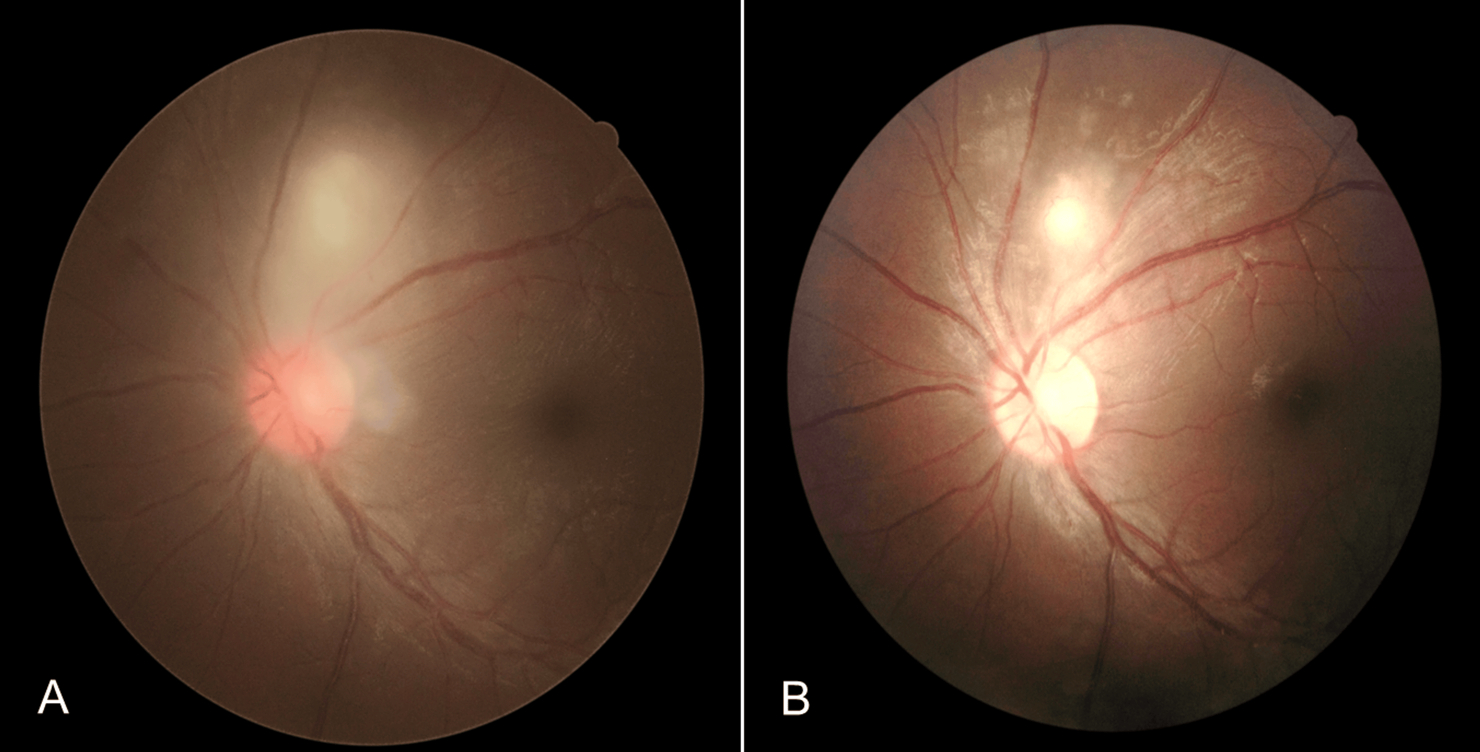 Atypical Ocular Toxoplasmosis With Remote Vasculitis and Kyrieleis