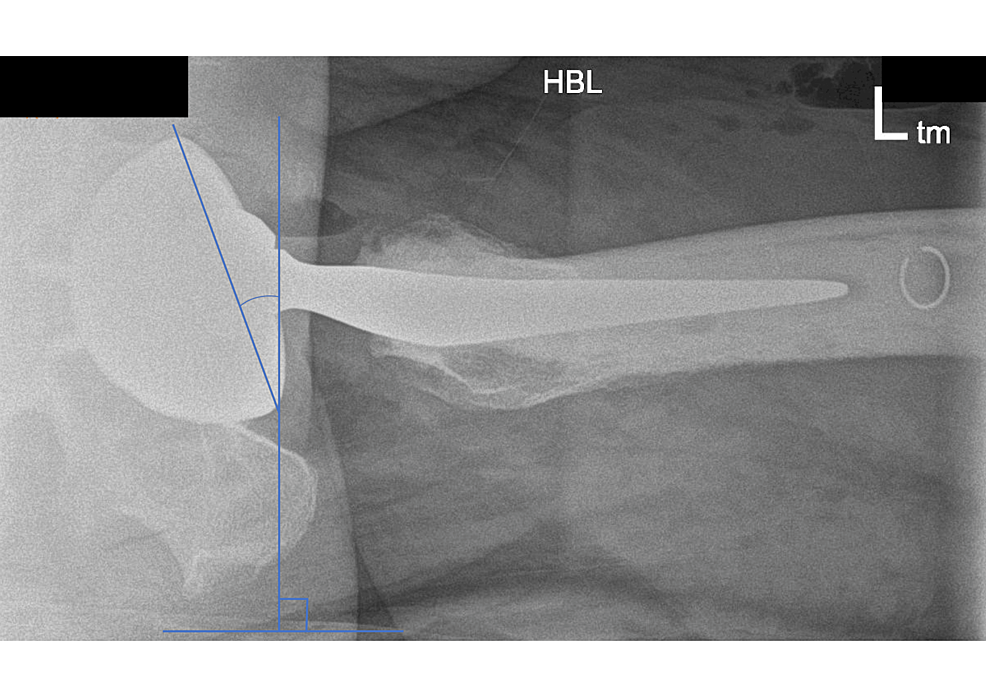 Cureus of Dual Mobility Bearings in Revision Total Hip