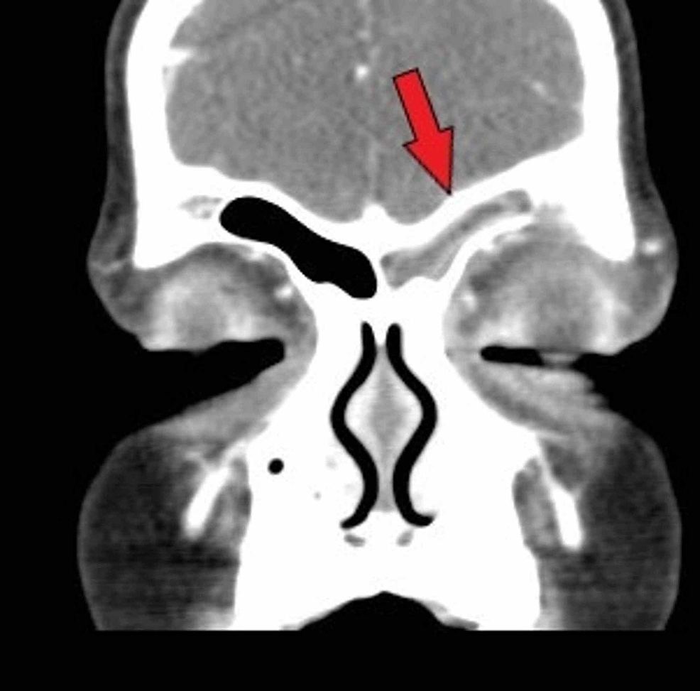 Infected Sinus Ct Scan