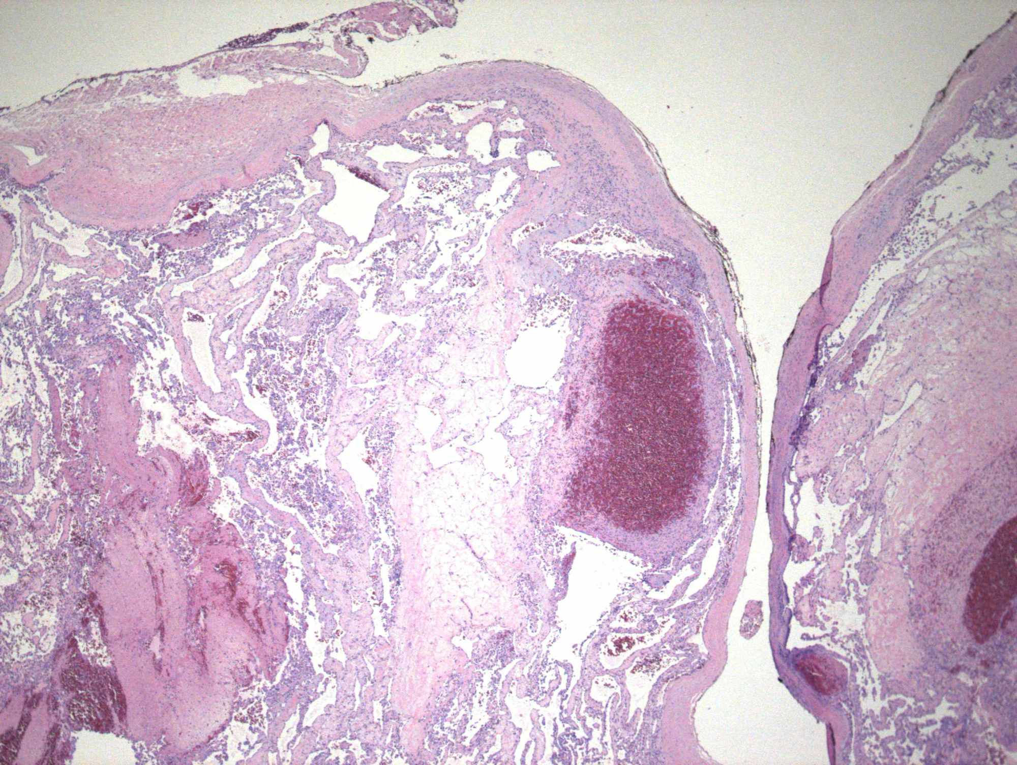 Cureus Intravascular Papillary Endothelial Hyperplasia Of The Orbit