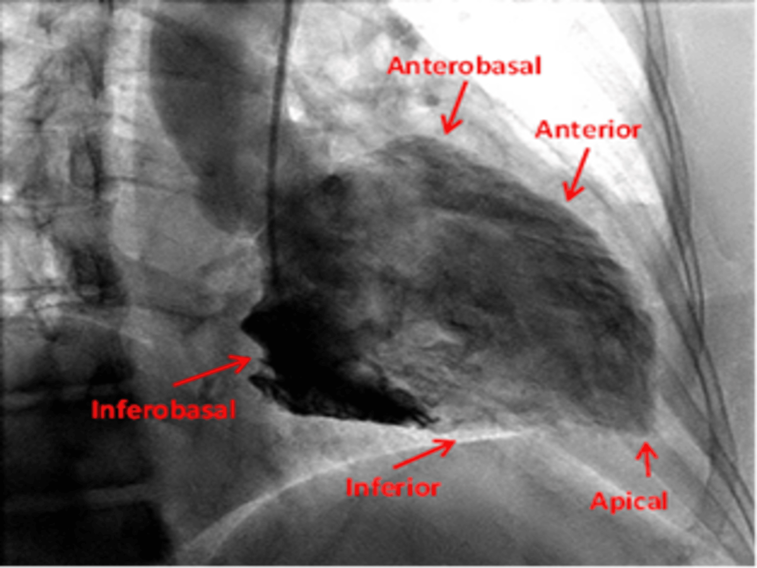 Cureus | Basic Overview of Conventional Coronary Angiography for ...