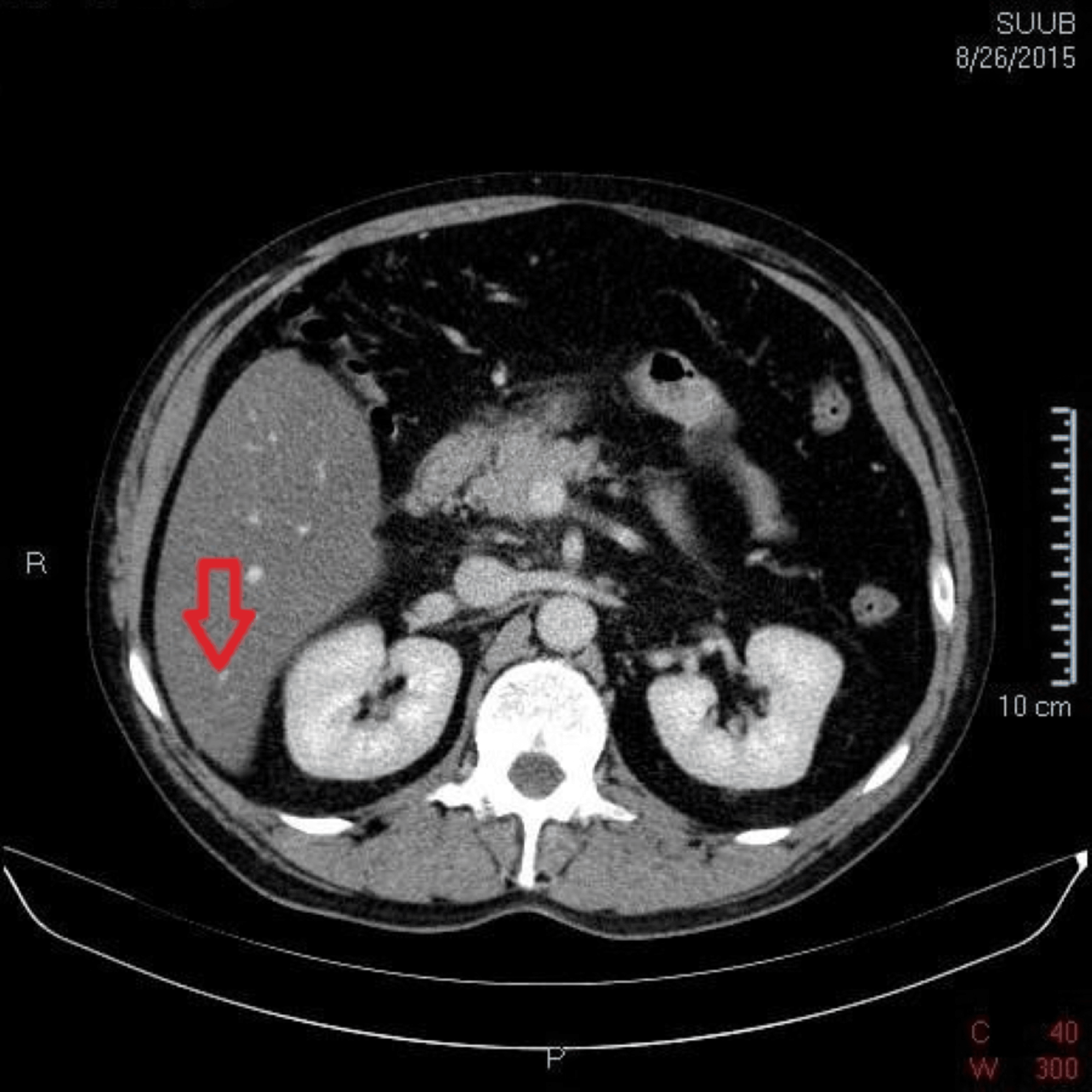 Cureus Unveiling the Unexpected Cooccurrence of Acute Pancreatitis