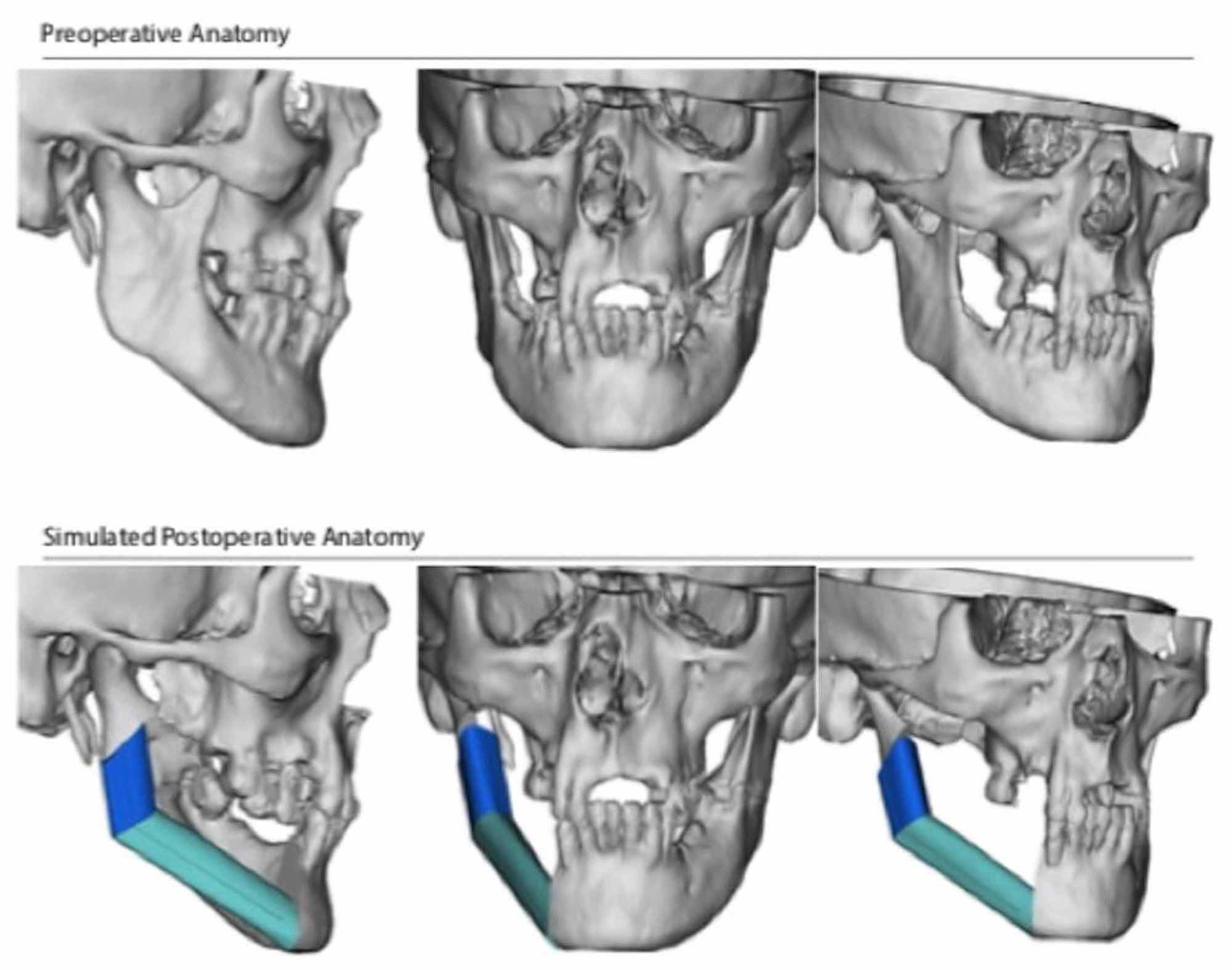 Cureus | Virtual Surgical Planning Computer-aided Design-guided ...