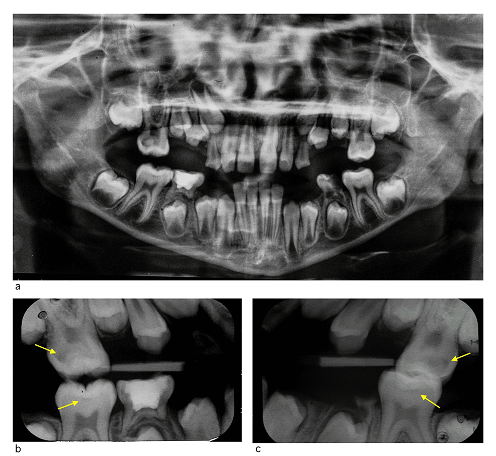 The Approach To Dental Caries Prevention In A Case Of Agenesis Of The ...