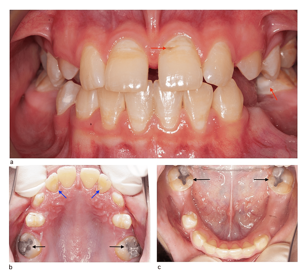 The Approach To Dental Caries Prevention In A Case Of Agenesis Of The ...