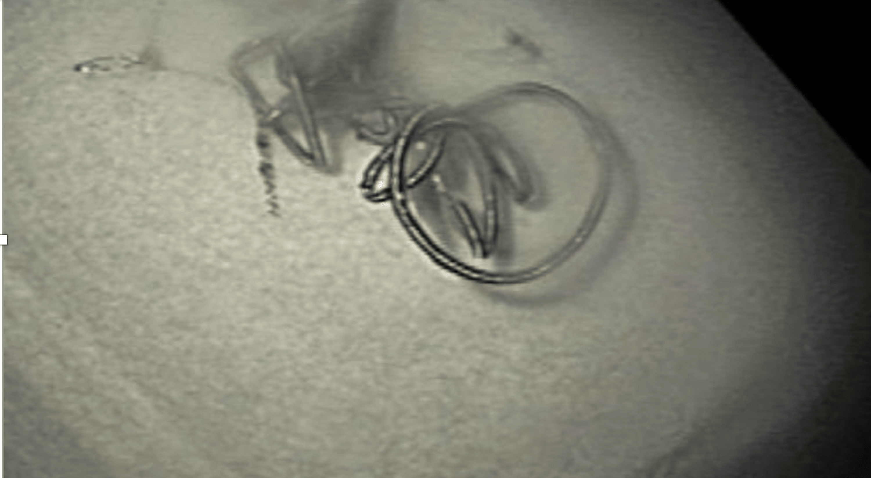 Recurrent Duodenal Ulcer After Gastroduodenal Artery Embolization Due