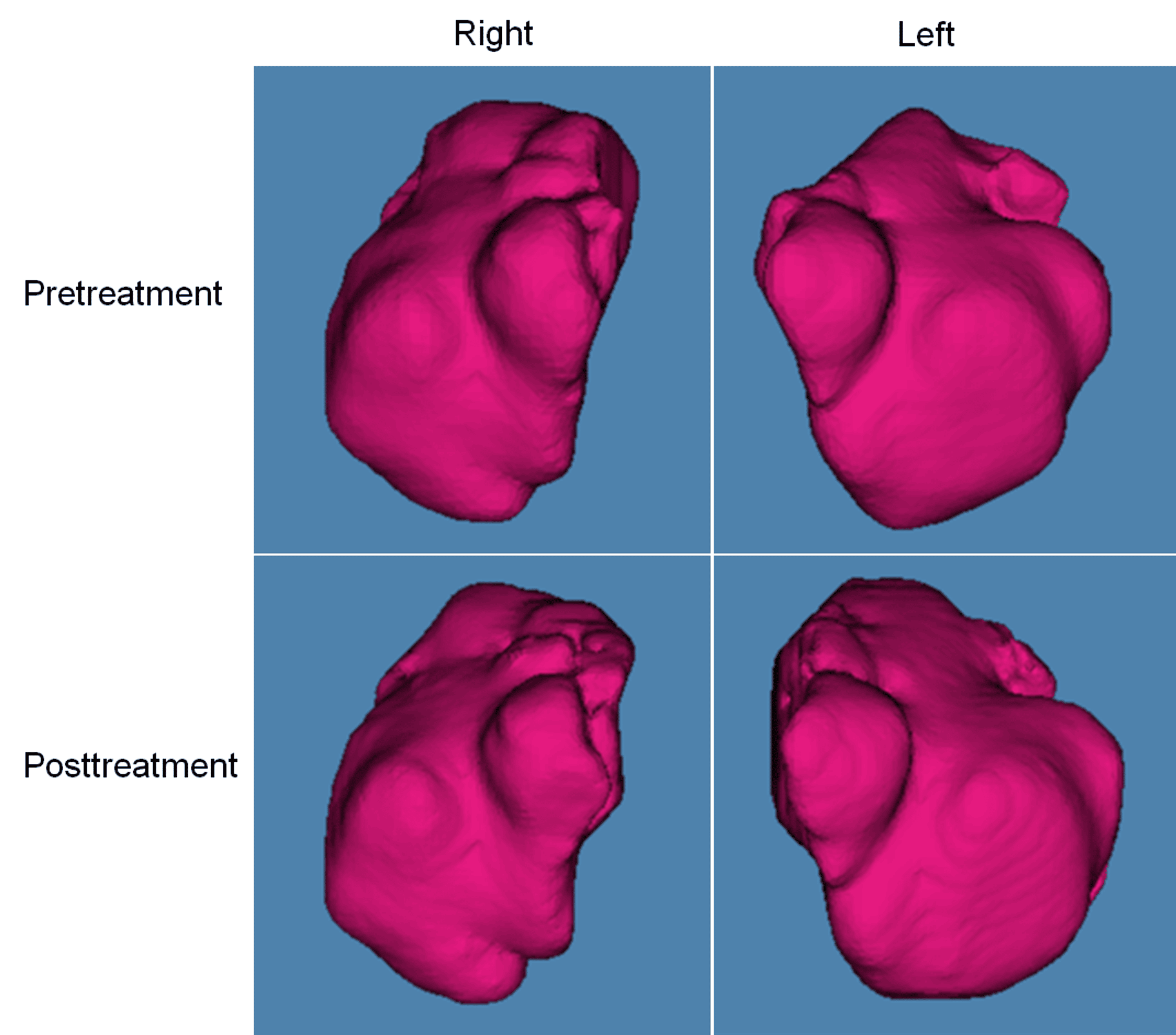 Influence of Orthodontic Treatment on Changes in the Maxillary Sinus