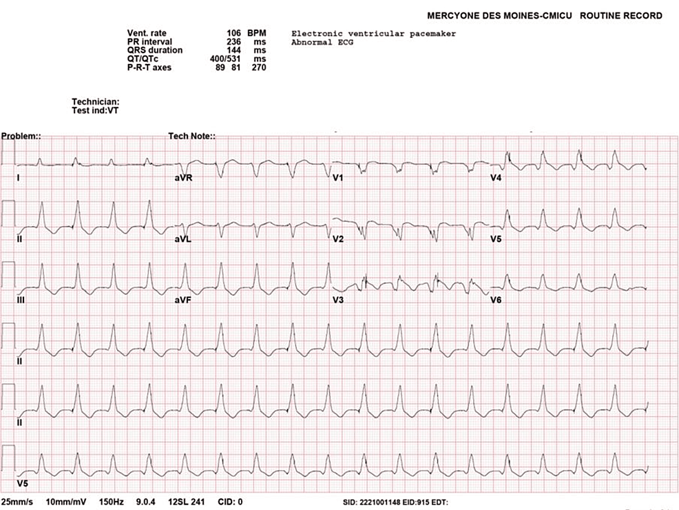 Eosinophilic Myocarditis Resulting in Ventricular Tachycardia Storm ...