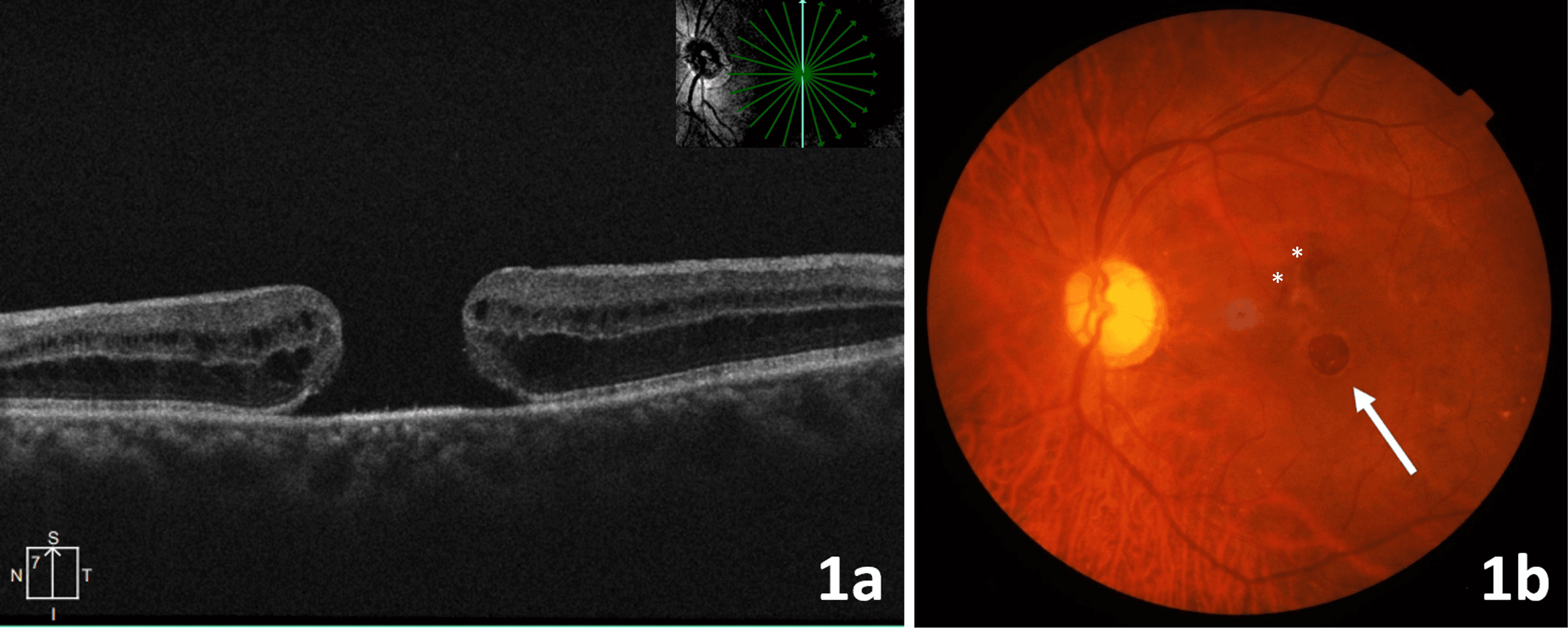 Severe Gliosis Over a Closed Macular Hole Following Anterior Lens