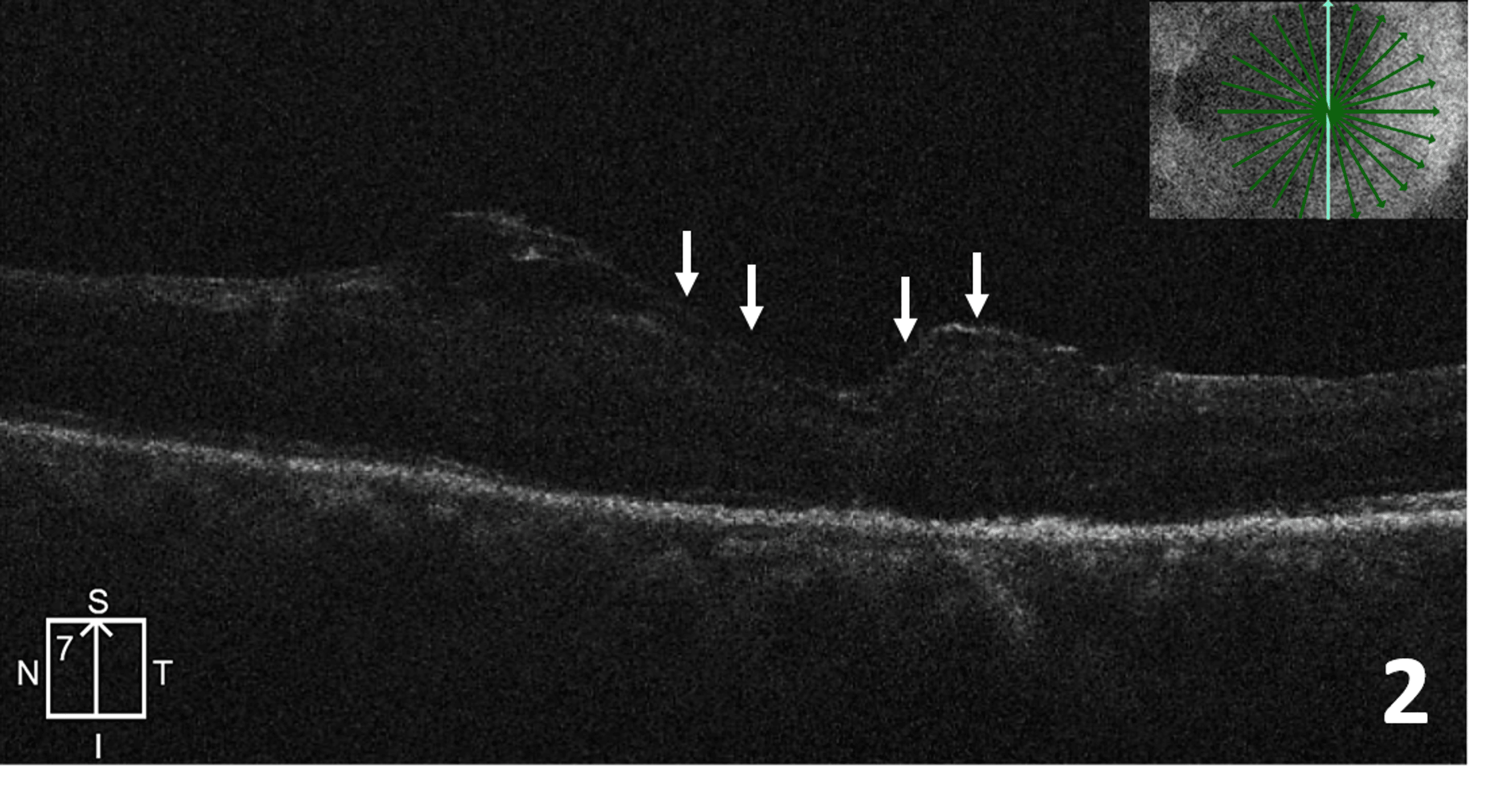 Severe Gliosis Over a Closed Macular Hole Following Anterior Lens